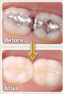 Mercury Free All Porcelain Fillings
